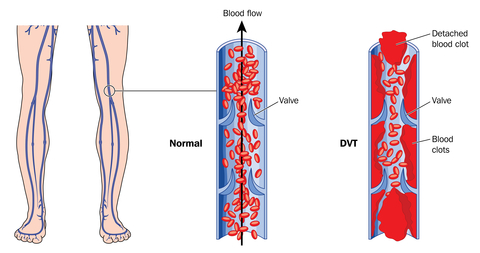 Deep Vein Thrombosis Diagram